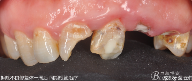 根管治疗或被一种化合物替代，企查查：深圳现存口腔相关企业最多